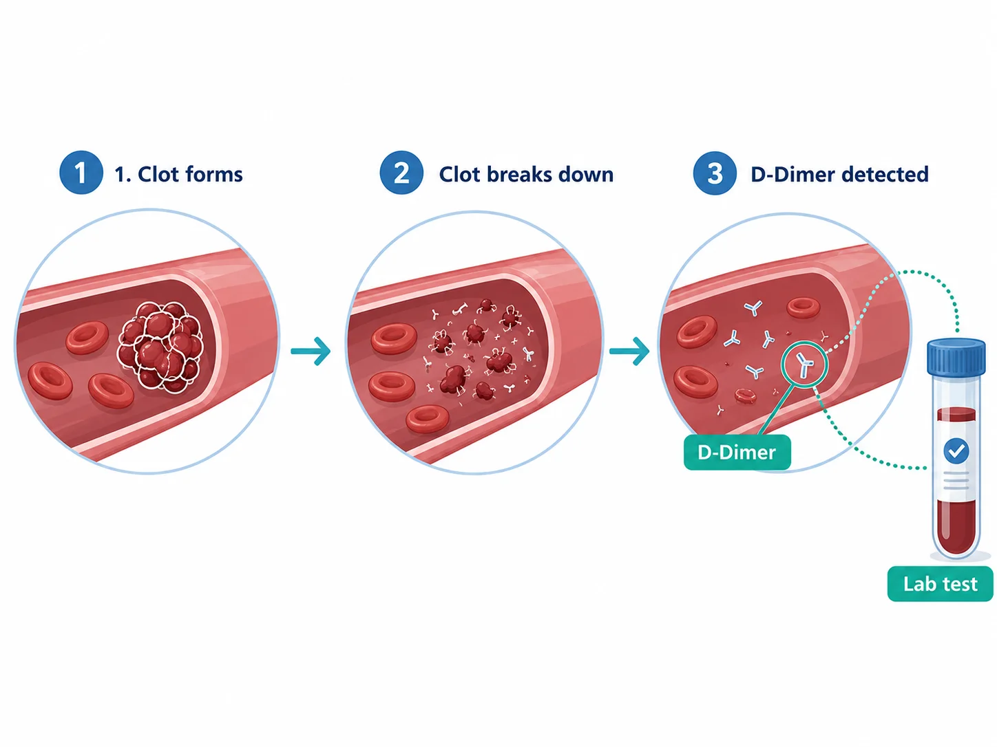 D-Dimer test explained: how a blood clot breaks down and releases D-Dimer fragments detected in a blood test